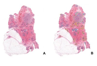Krebszellen unter dem Mikroskop