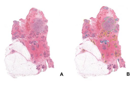 Krebszellen unter dem Mikroskop